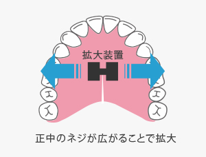 拡大床（かくだいしょう）