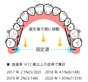 歯科矯正用アンカースクリューの利用