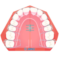 歯並びのアーチ（歯列）を広げる
