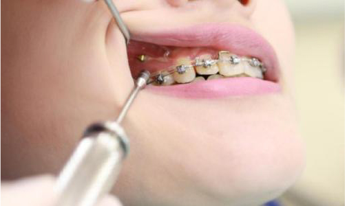歯科矯正用アンカースクリューを使用した矯正治療