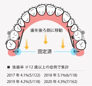 当院の治療に欠かせない歯科矯正用アンカースクリュー