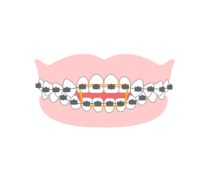 歯並び・咬み合わせに対する治療