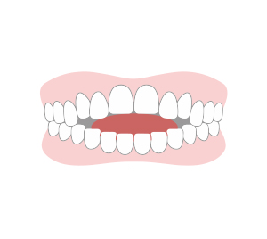 舌の癖に対する治療