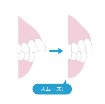 歯を引っこめるのに適した装置