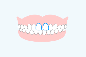 すきっ歯(空隙歯列)
