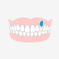 先天性欠損や埋伏歯