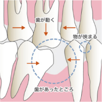 周囲の歯の移動