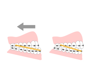 歯並び・咬み合わせに対する治療