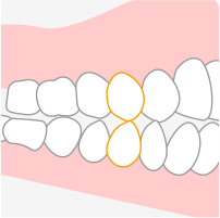 奥歯に負担がかかる